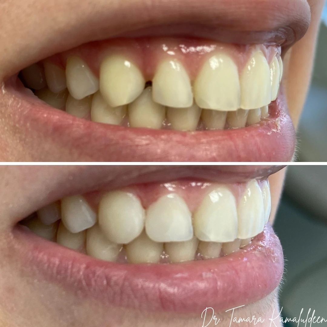 Composite bonding before and after case 1