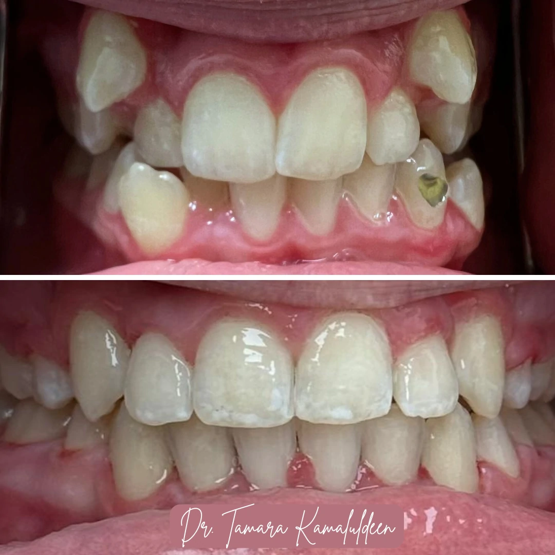 Orthodontic crowding correction before and after at North Star Dentistry Mississauga