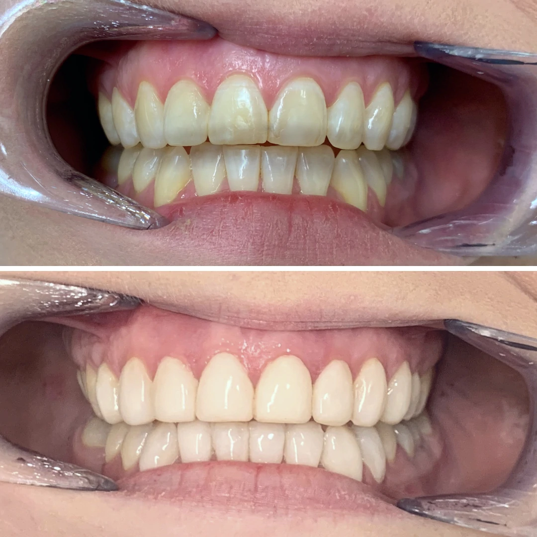 Composite bonding before and after case 2