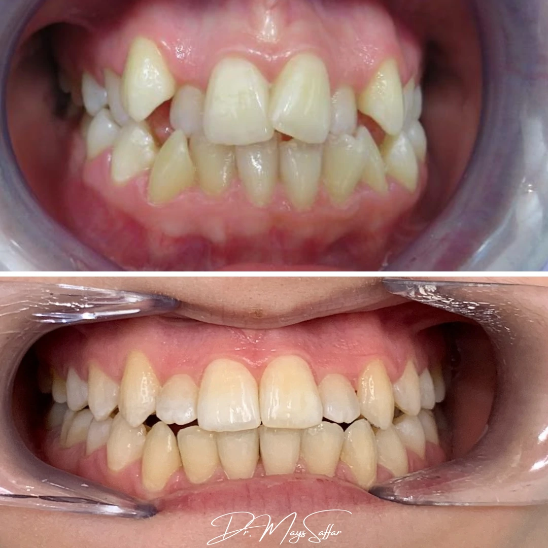 Orthodontic bite alignment before and after case performed in Mississauga