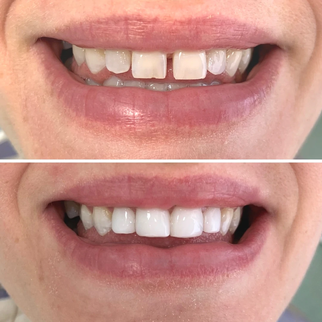 Composite bonding before and after case 5