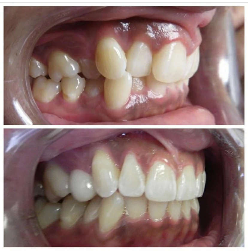 Orthodontic protruding teeth correction before and after at North Star Dentistry Mississauga