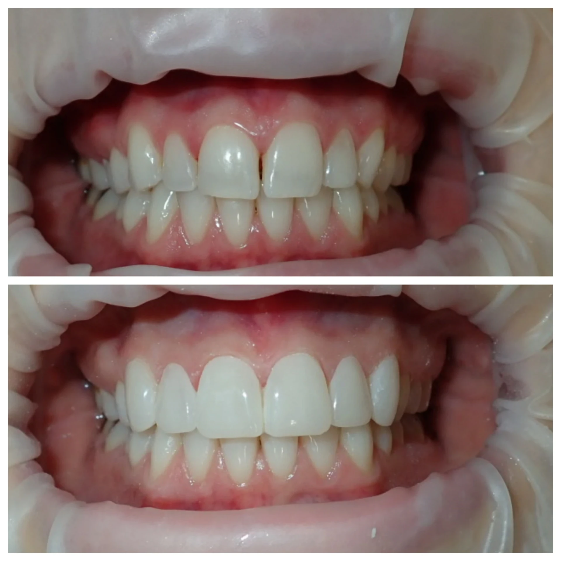 Composite bonding before and after case 6