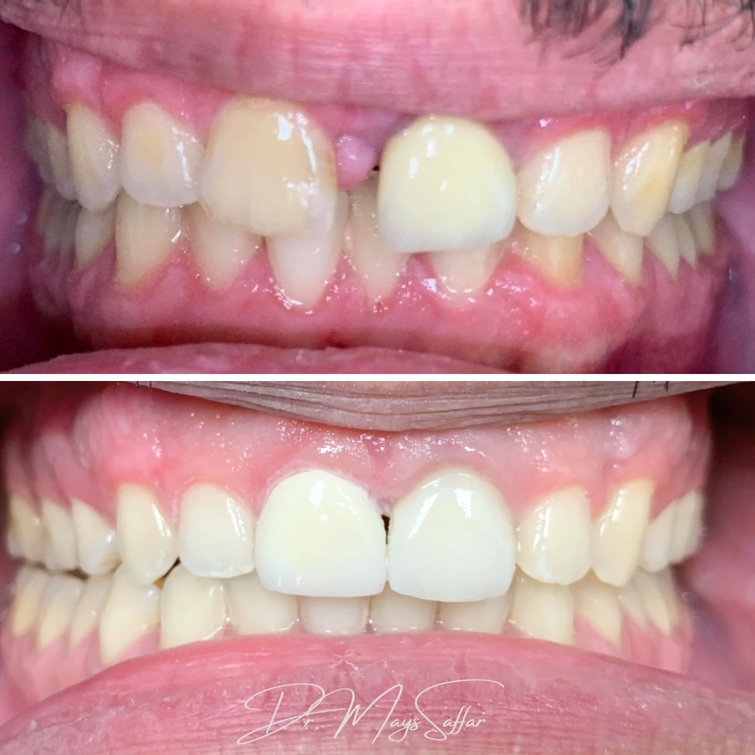 Orthodontic front teeth gap closure before and after at North Star Dentistry Mississauga