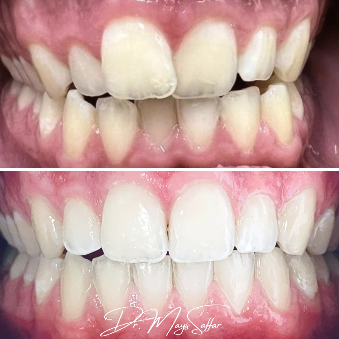 Orthodontic crowding correction before and after showing straighter teeth in Mississauga