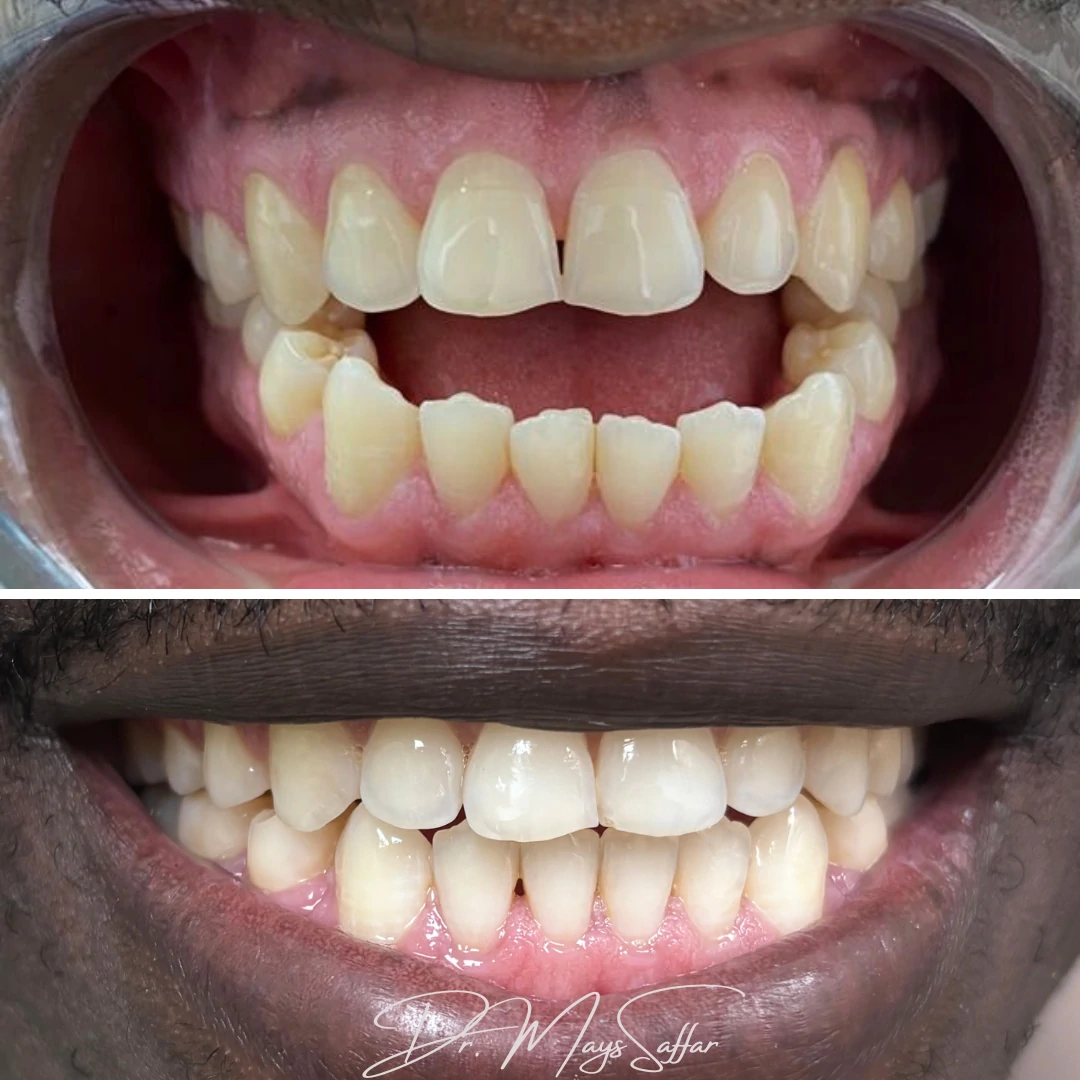 Orthodontic severe crowding correction before and after showing full arch alignment in Mississauga