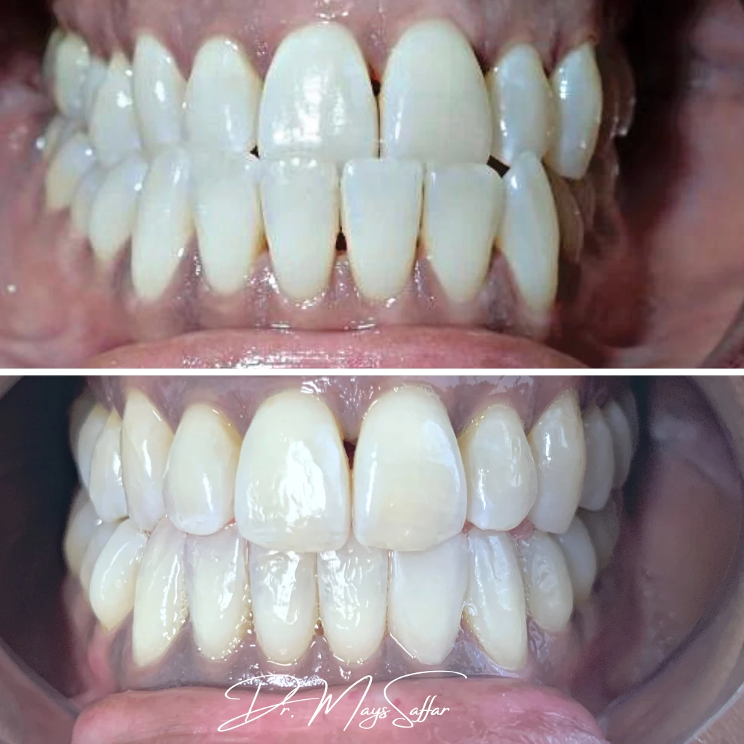Orthodontic teeth alignment and spacing correction before and after at North Star Dentistry