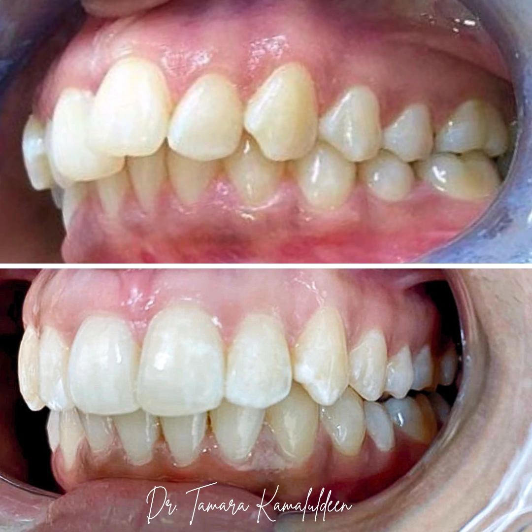 Orthodontic bite correction before and after by Dr. Tamara Kamaluldeen in Mississauga