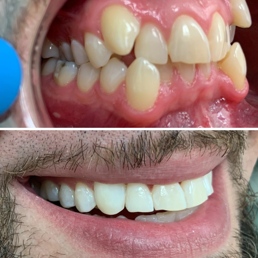 Orthodontic severe malocclusion correction before and after at North Star Dentistry Mississauga