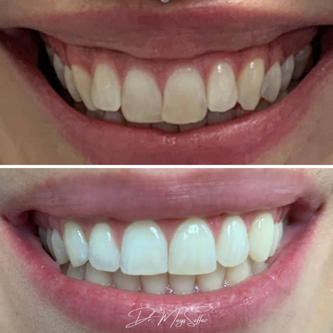 Clear aligner orthodontic treatment before and after showing straightened smile at North Star Dentistry Mississauga