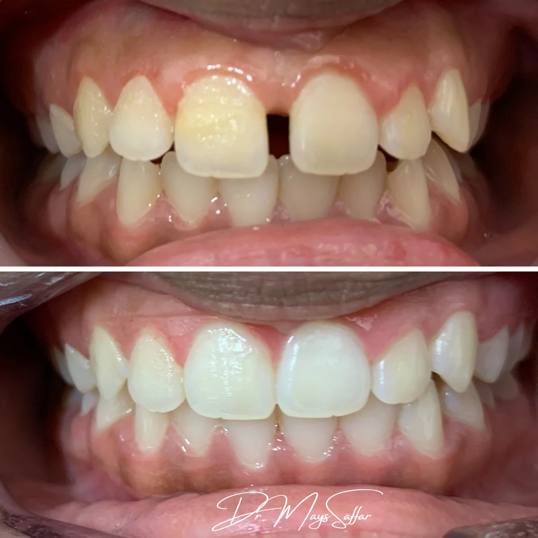 Orthodontic gap closure before and after with clear aligners in Mississauga