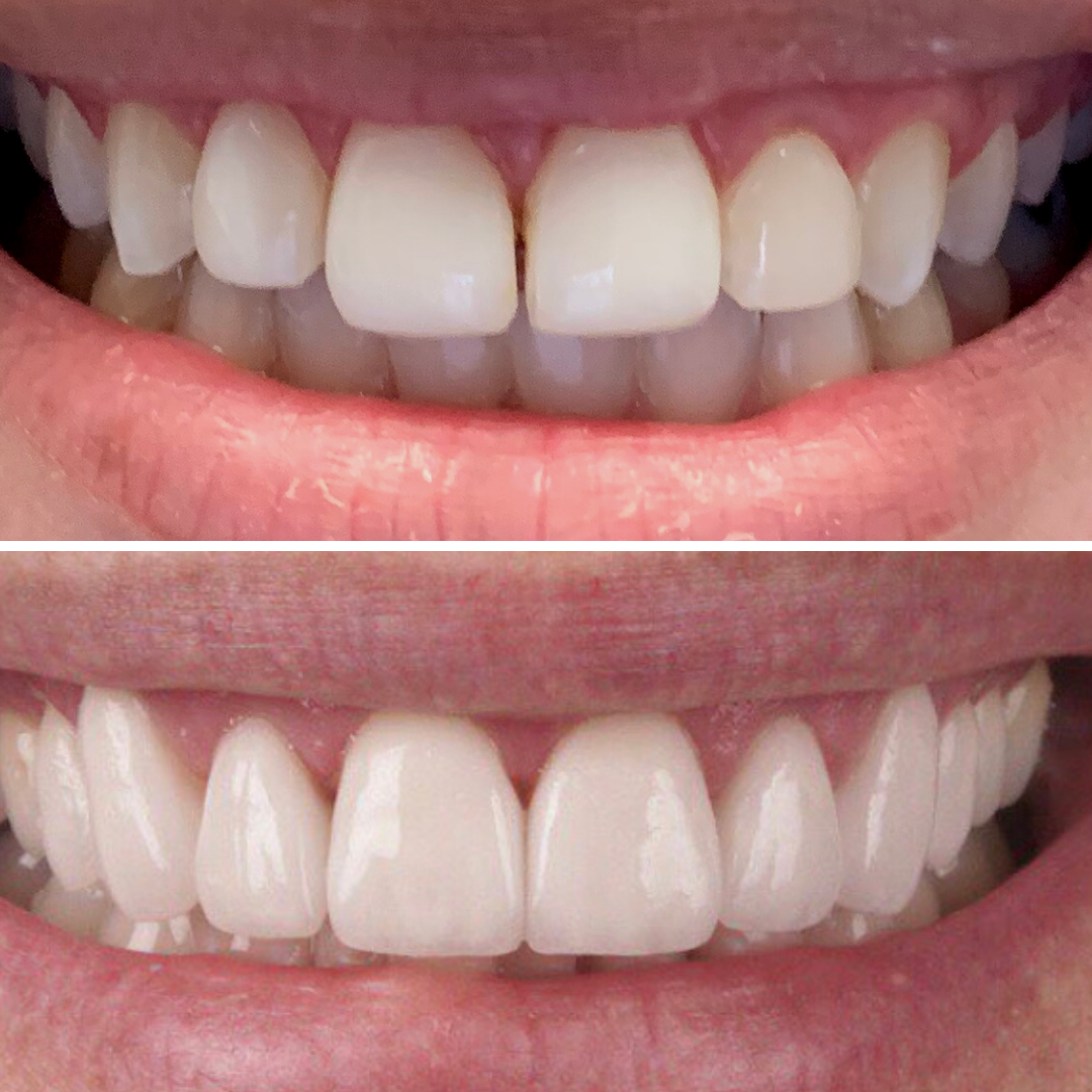 Porcelain veneers before and after showing brighter, balanced front teeth at North Star Dentistry Mississauga