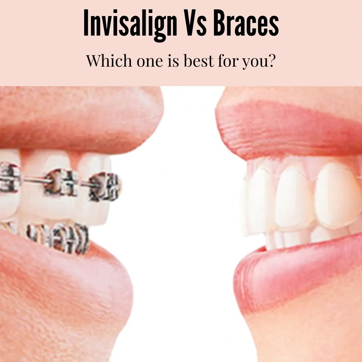 Invisalign vs Braces (In-depth)