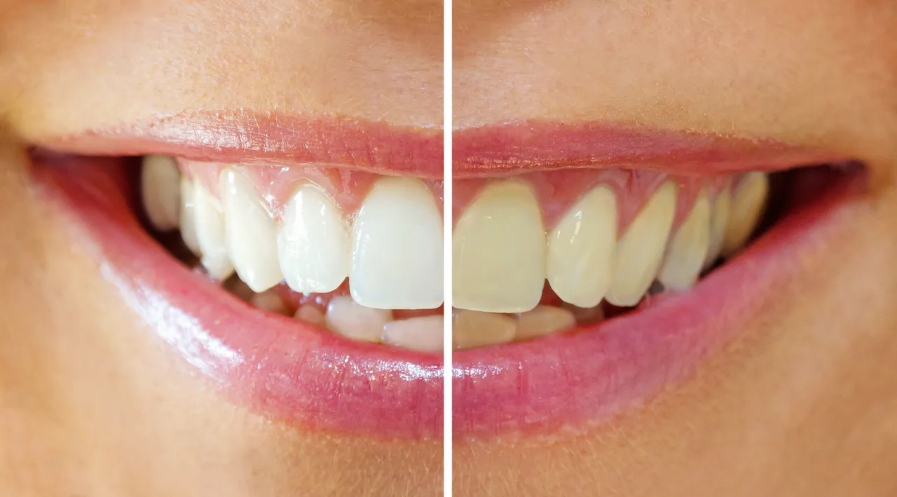 Teeth Whitening Guide