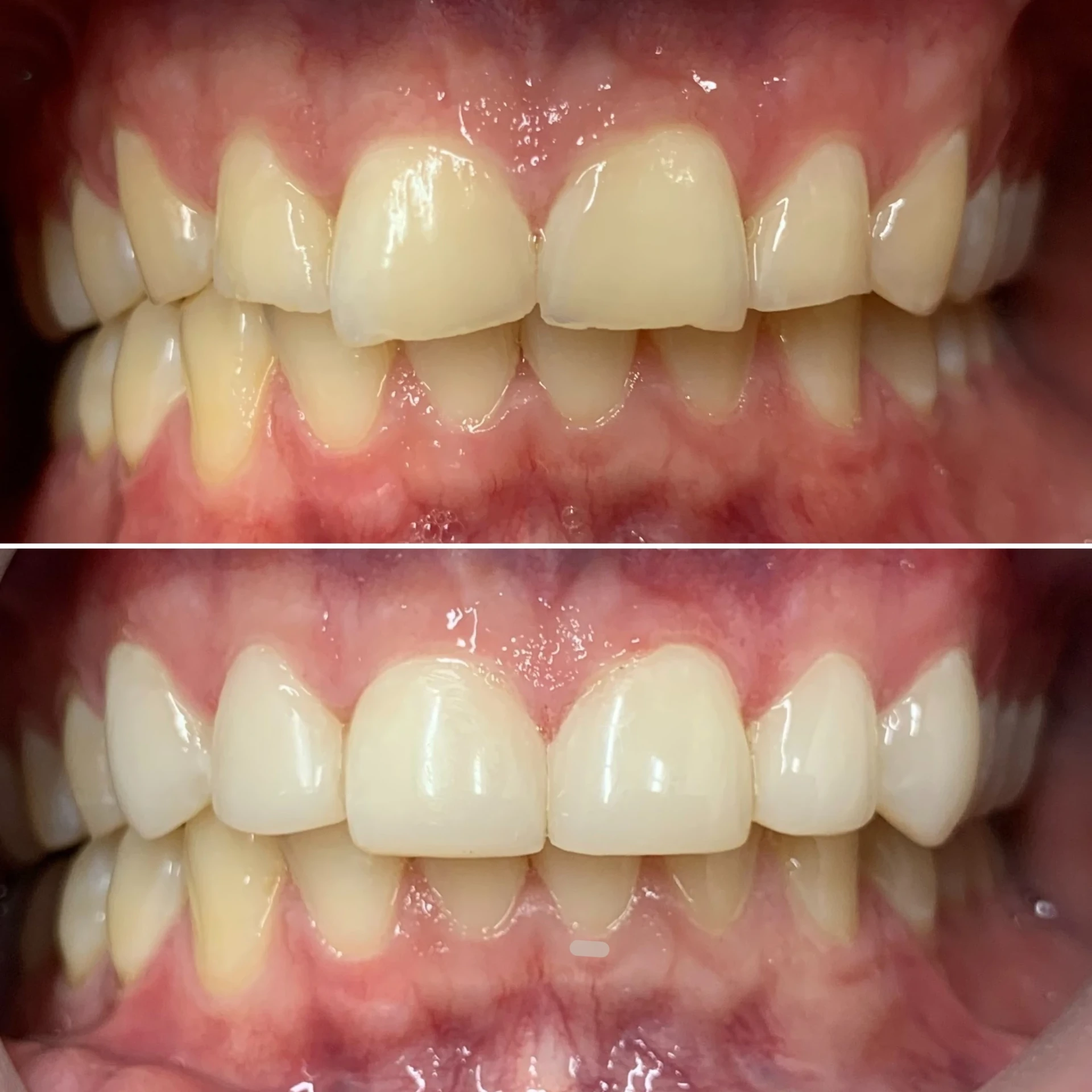 Composite bonding transformation