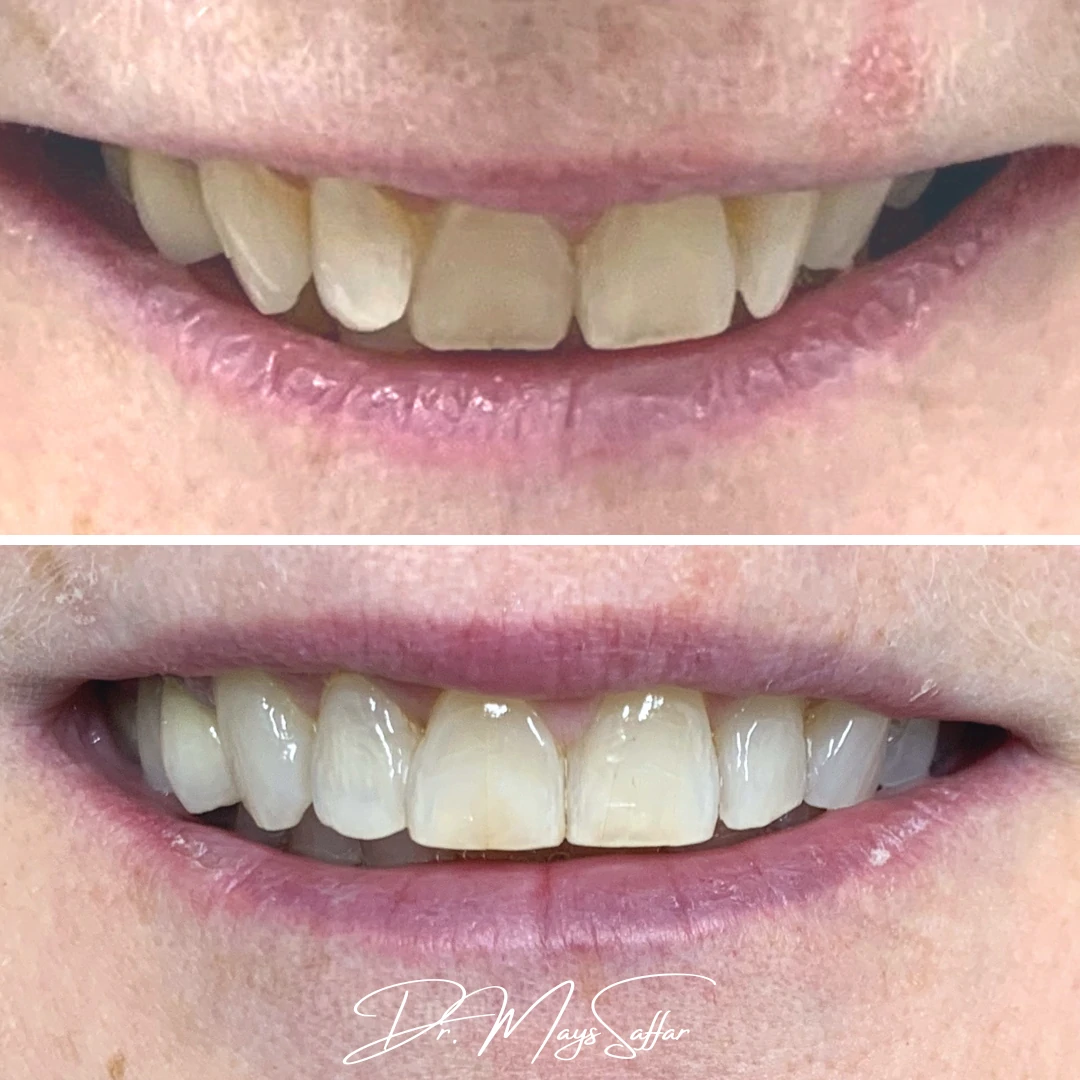 Orthodontic smile improvement before and after with clear aligners at North Star Dentistry