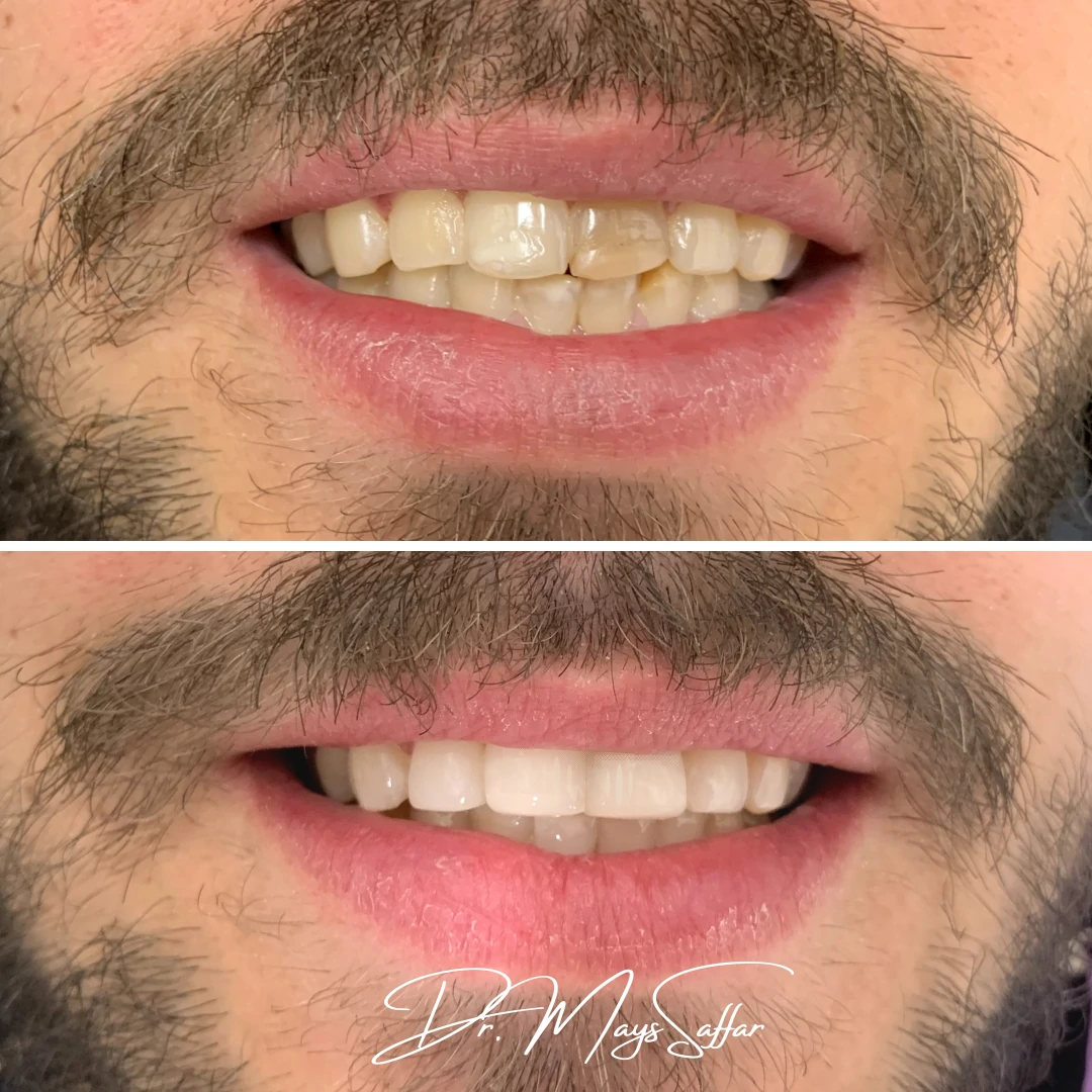 Composite bonding case 4