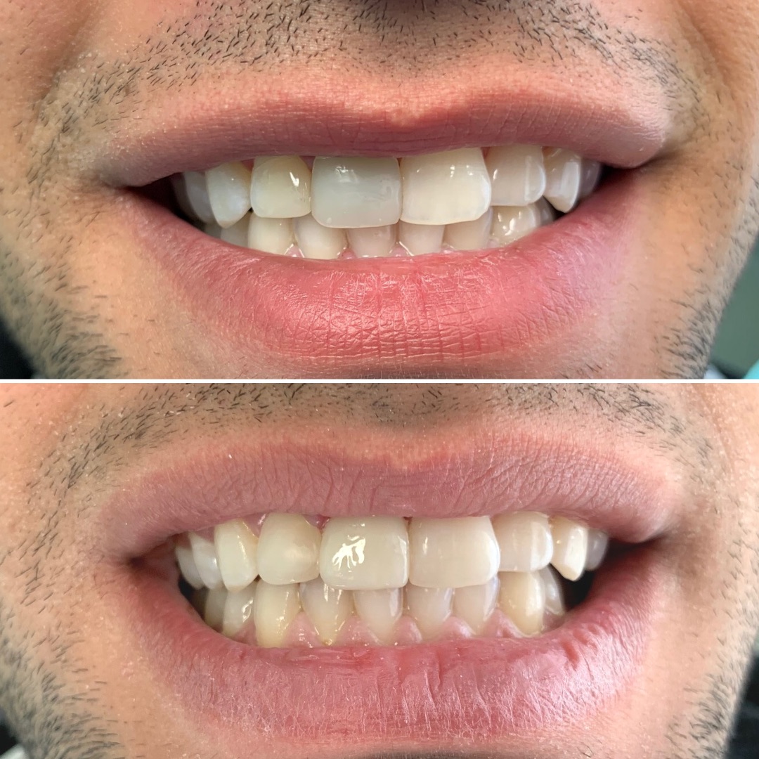 Porcelain veneers before and after correcting chipped and uneven front teeth in Mississauga