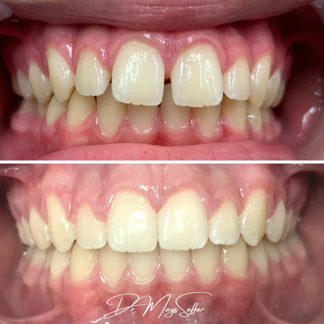 Orthodontic spacing correction before and after in Mississauga