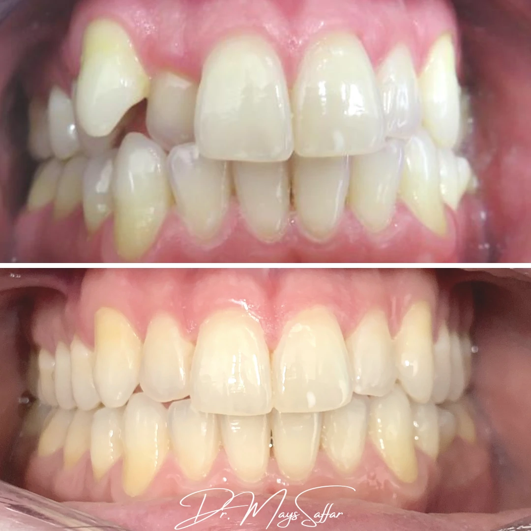 Orthodontic crossbite correction before and after at North Star Dentistry Mississauga