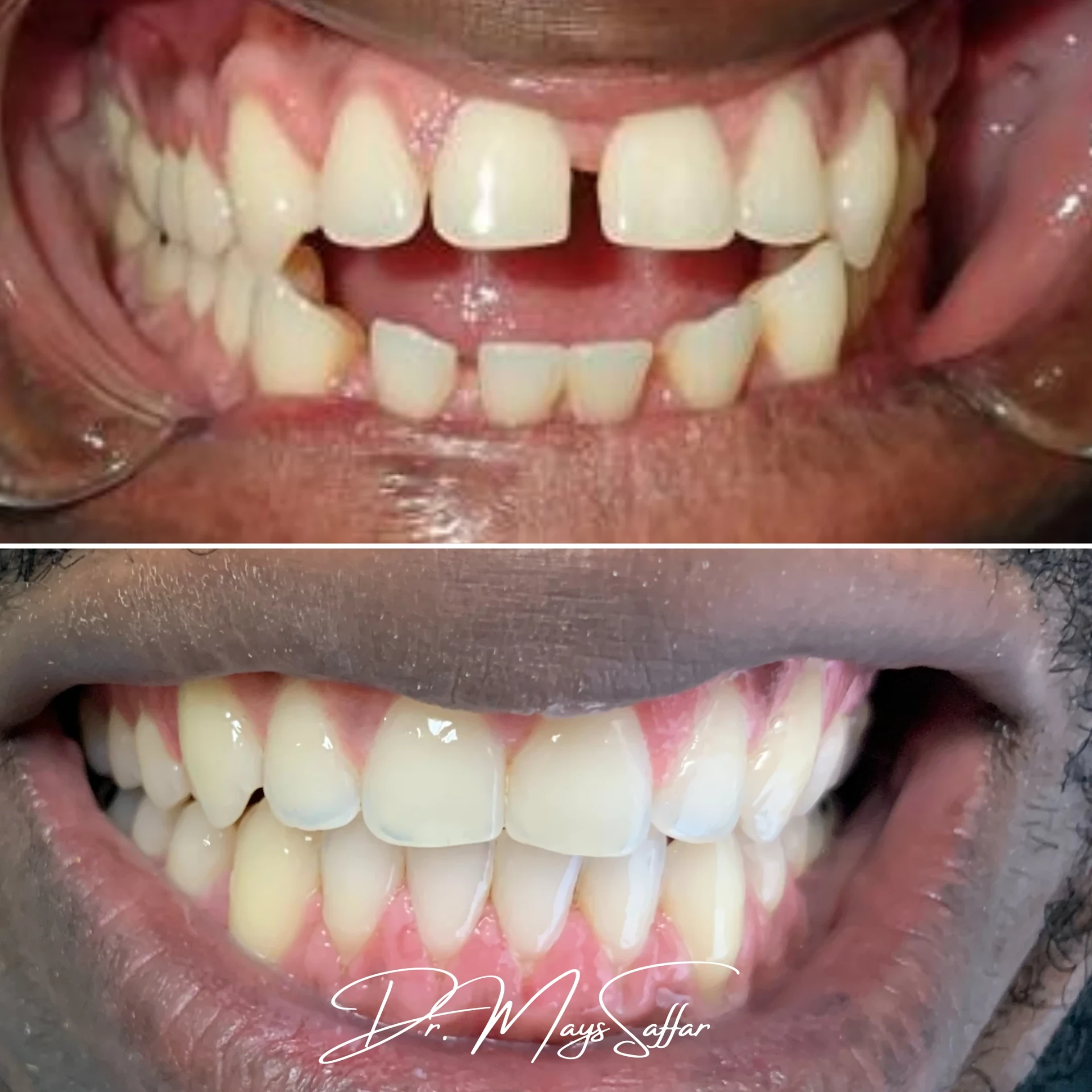 Orthodontic missing tooth gap closure before and after in Mississauga