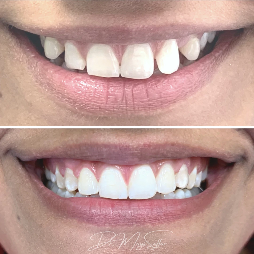 Orthodontic front teeth alignment before and after at North Star Dentistry