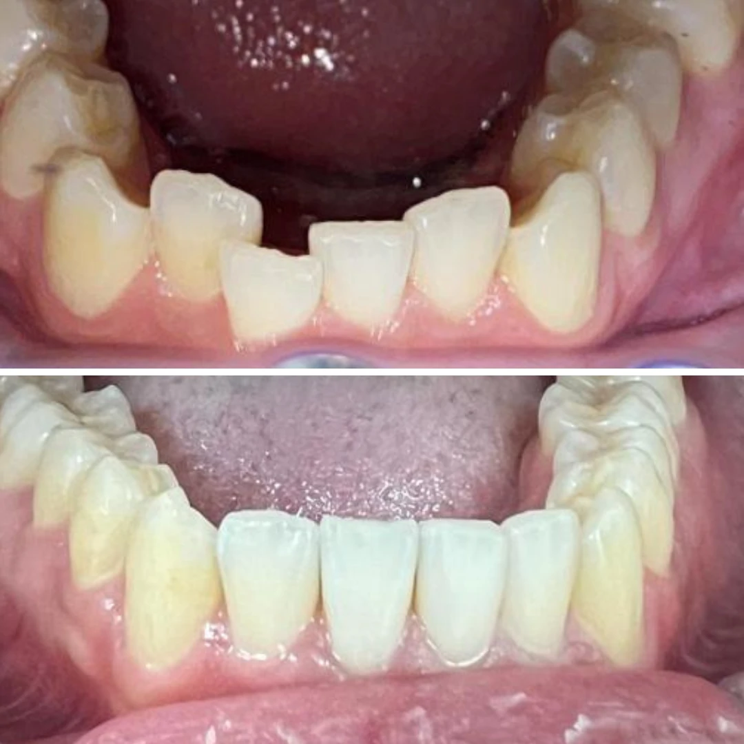 Orthodontic lower teeth crowding correction before and after in Mississauga
