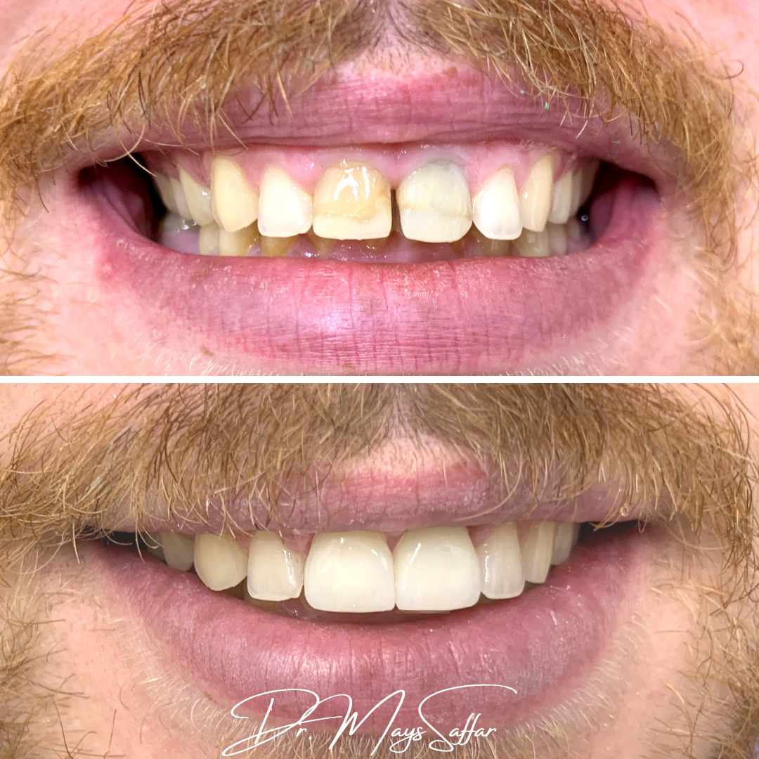 Porcelain crowns before and after restoring discoloured front teeth by Dr. Mays Saffar at North Star Dentistry Mississauga