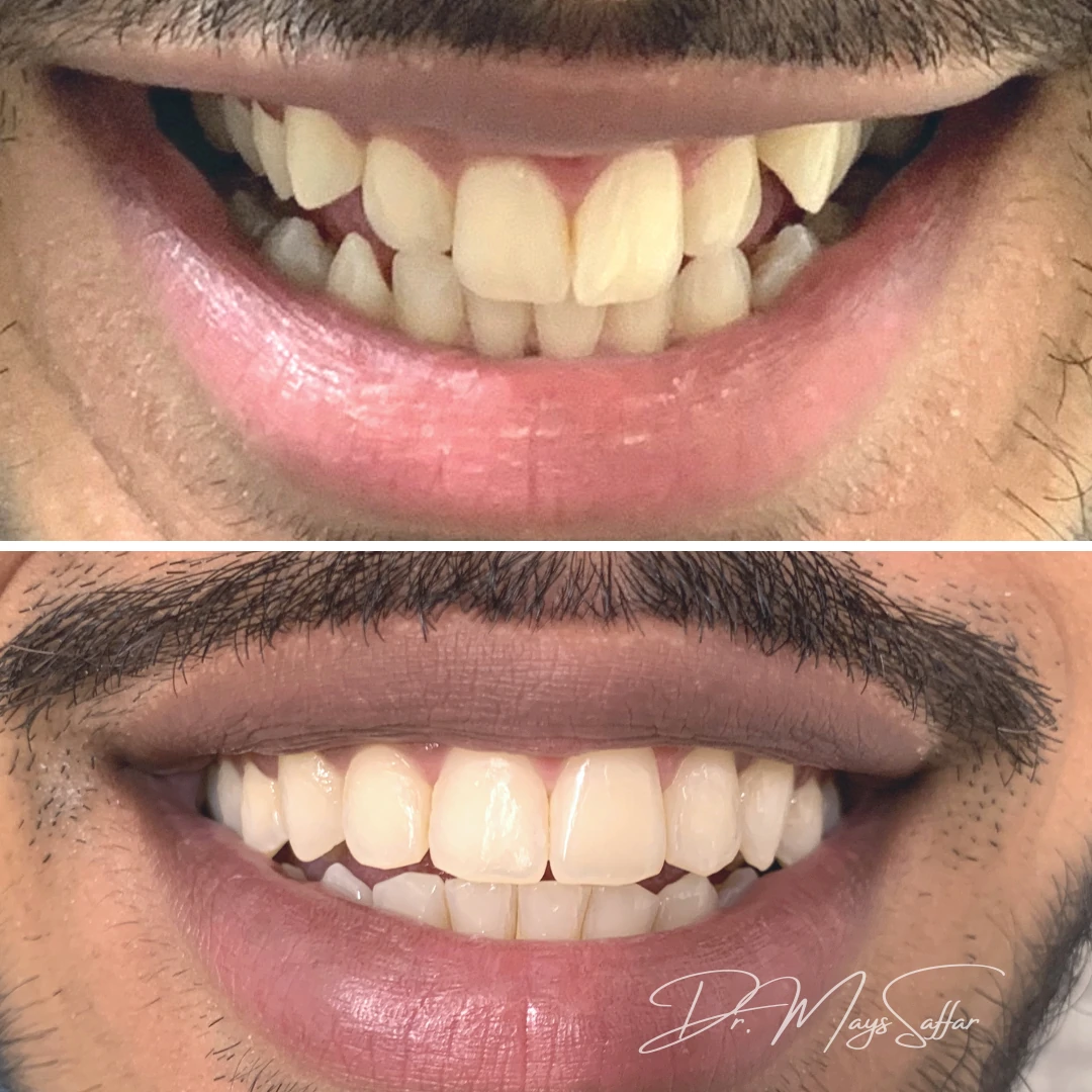 Orthodontic crowding and spacing correction before and after in Mississauga