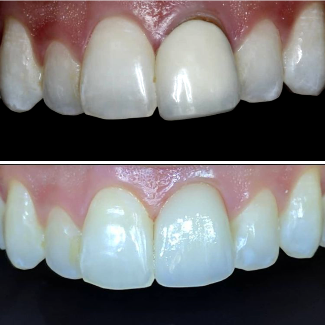 Single porcelain crown before and after on a discoloured central incisor at North Star Dentistry Mississauga