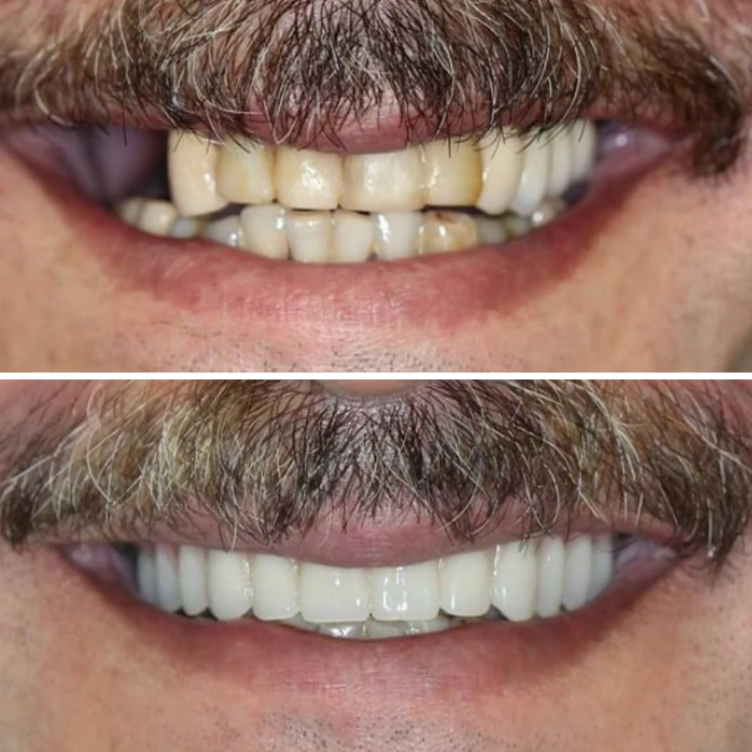 Dental implant full-arch restoration before and after at North Star Dentistry Mississauga