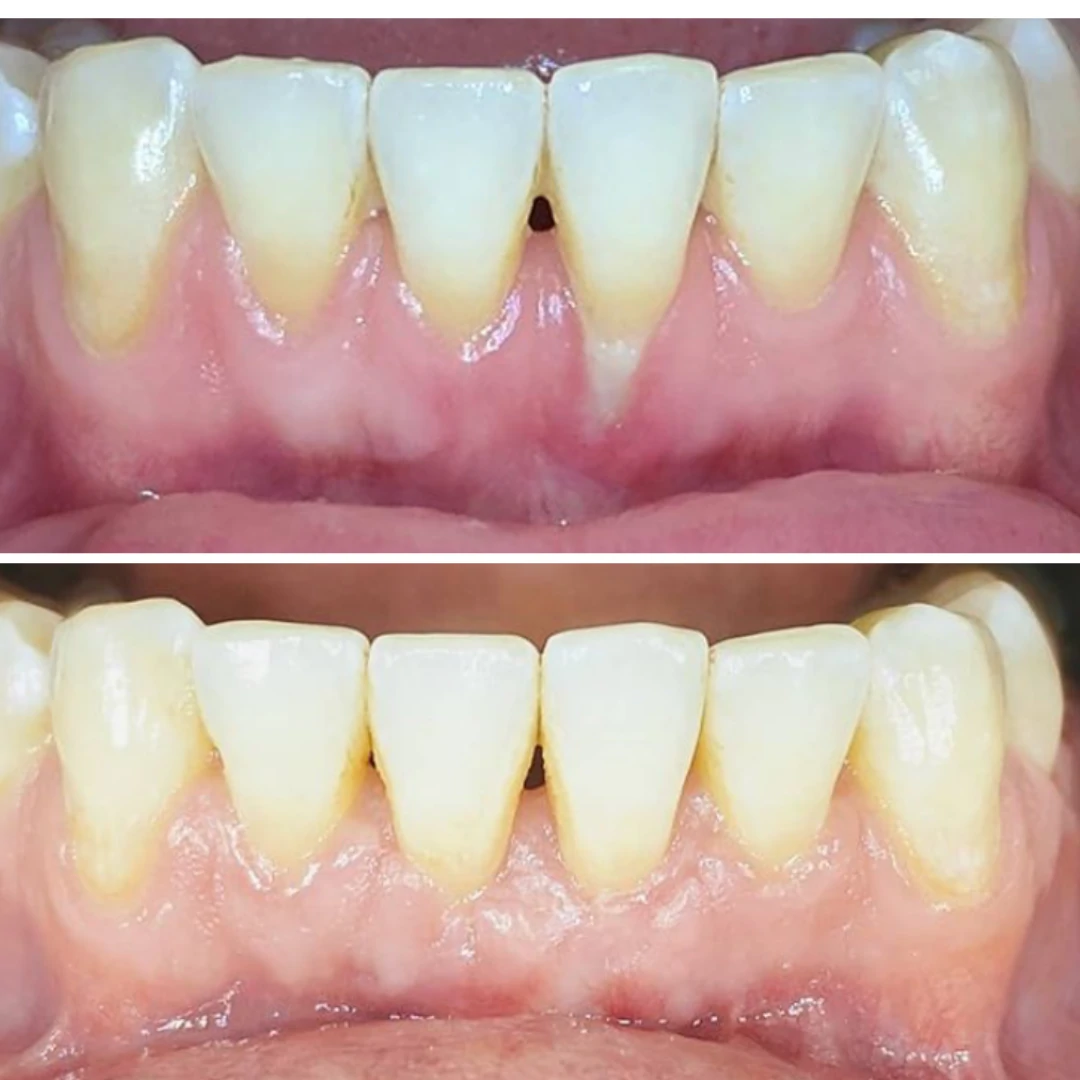 Gum surgery before and after showing improved gum tissue health and alignment in Mississauga