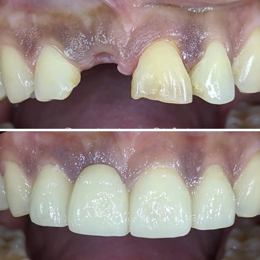 Single tooth dental implant before and after replacing missing front tooth at North Star Dentistry