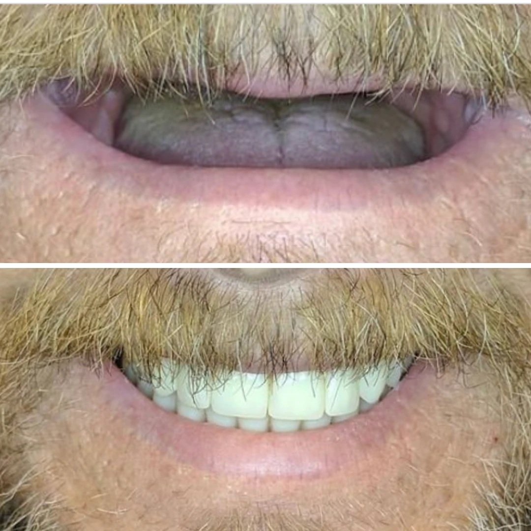 Implant-supported denture before and after showing complete smile restoration in Mississauga