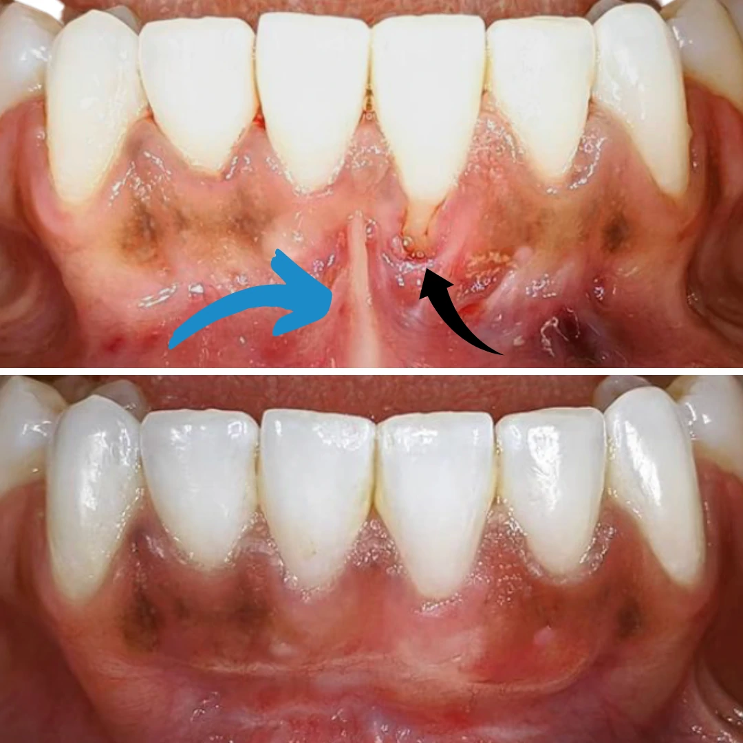 Gum grafting procedure results with tissue regeneration at North Star Dentistry Mississauga