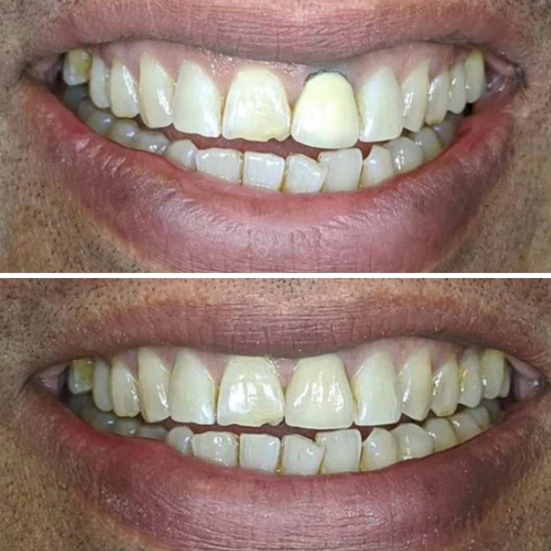 Porcelain crown before and after restoring a darkened front tooth in Mississauga