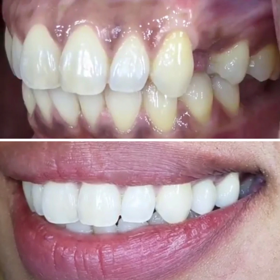 Dental implant bite correction before and after case performed in Mississauga