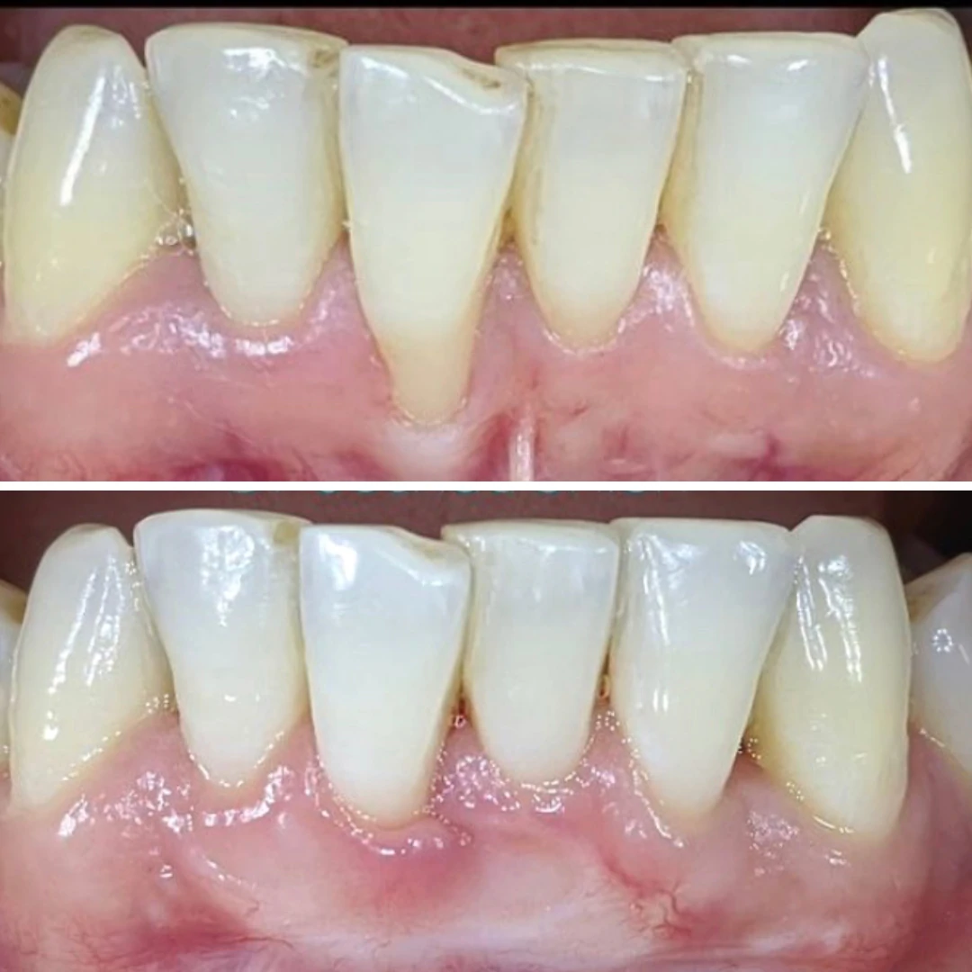 Crown lengthening before and after case performed at North Star Dentistry in Mississauga