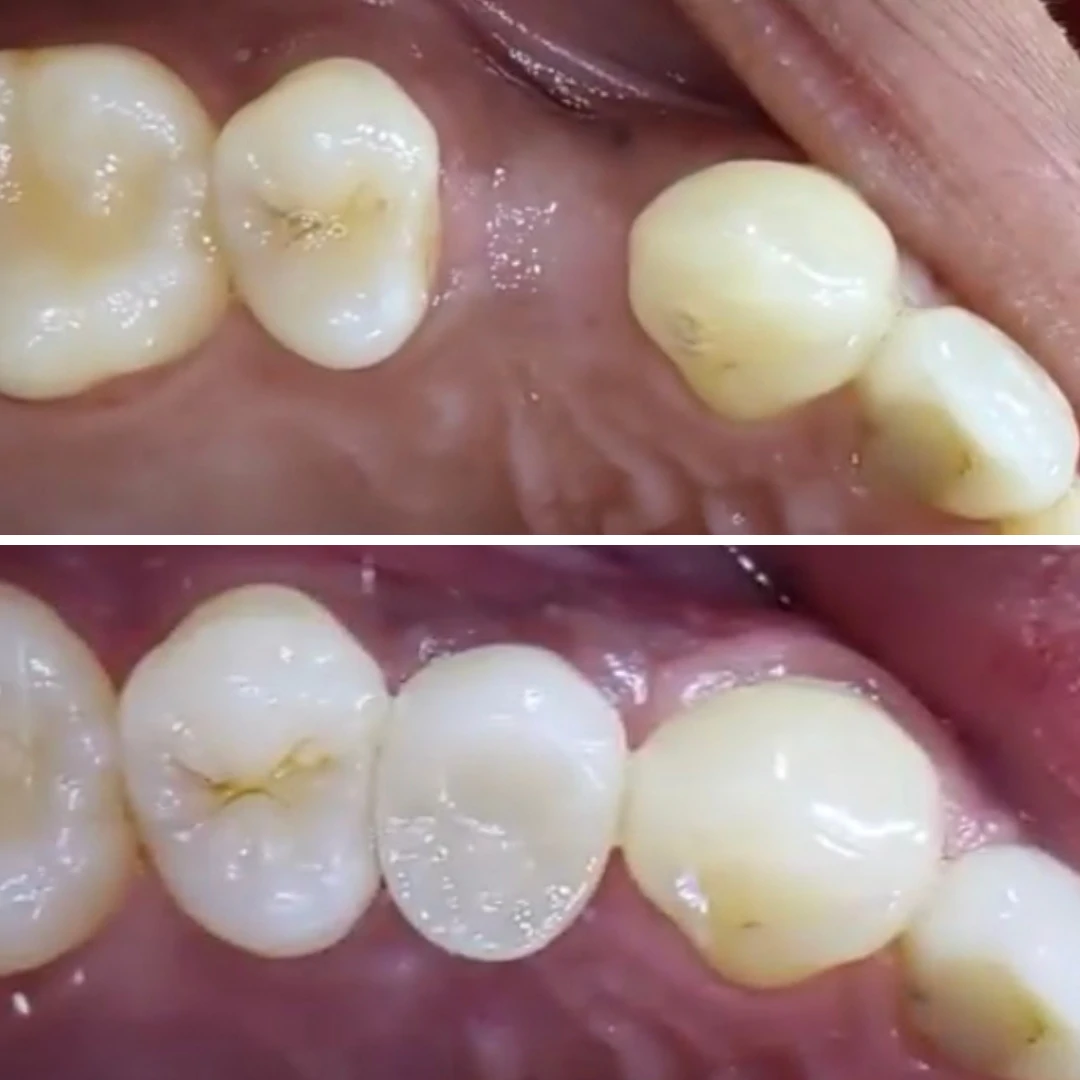Implant crown restoration before and after on posterior teeth at North Star Dentistry Mississauga