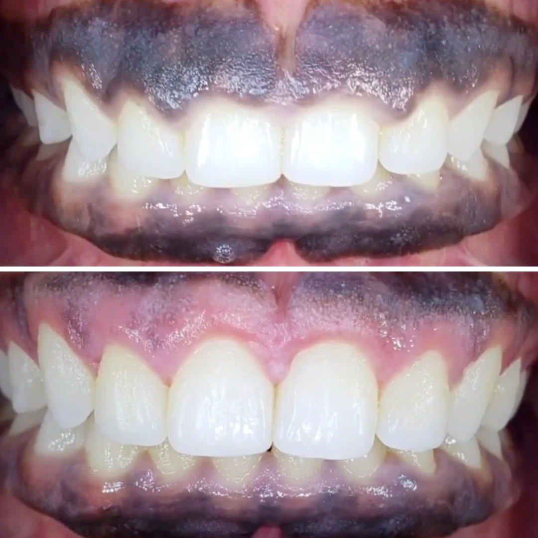 Gummy smile correction before and after showing balanced gum line at North Star Dentistry Mississauga