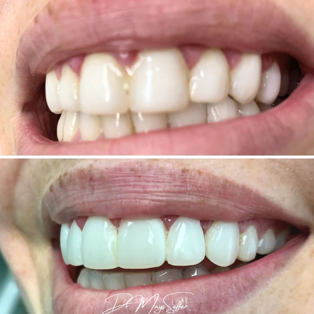 Composite bonding result
