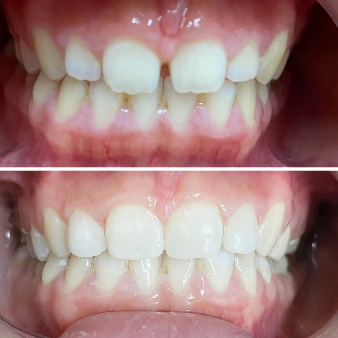 Orthodontic bite and alignment correction before and after in Mississauga