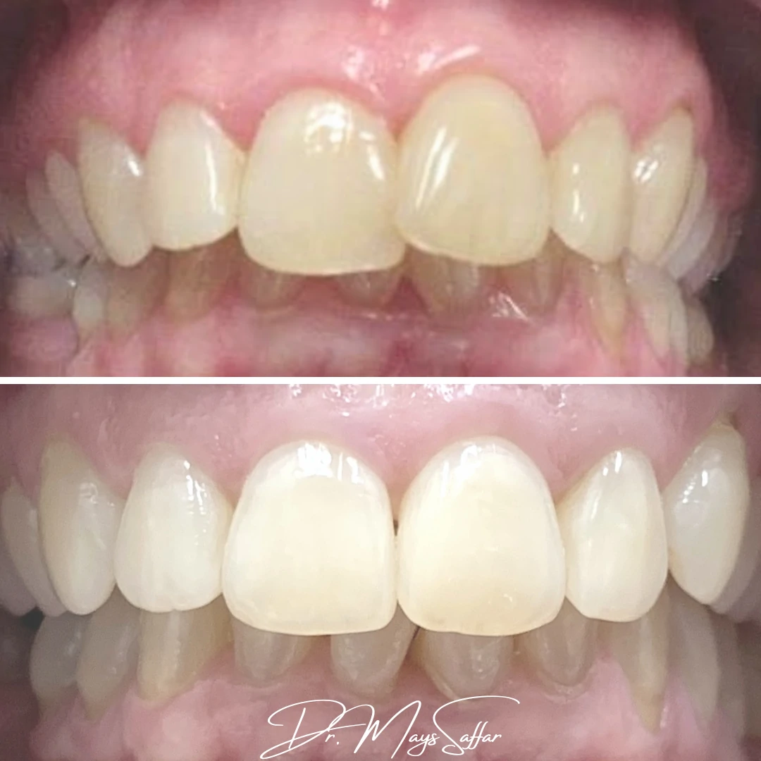 Orthodontic upper teeth alignment before and after at North Star Dentistry Mississauga