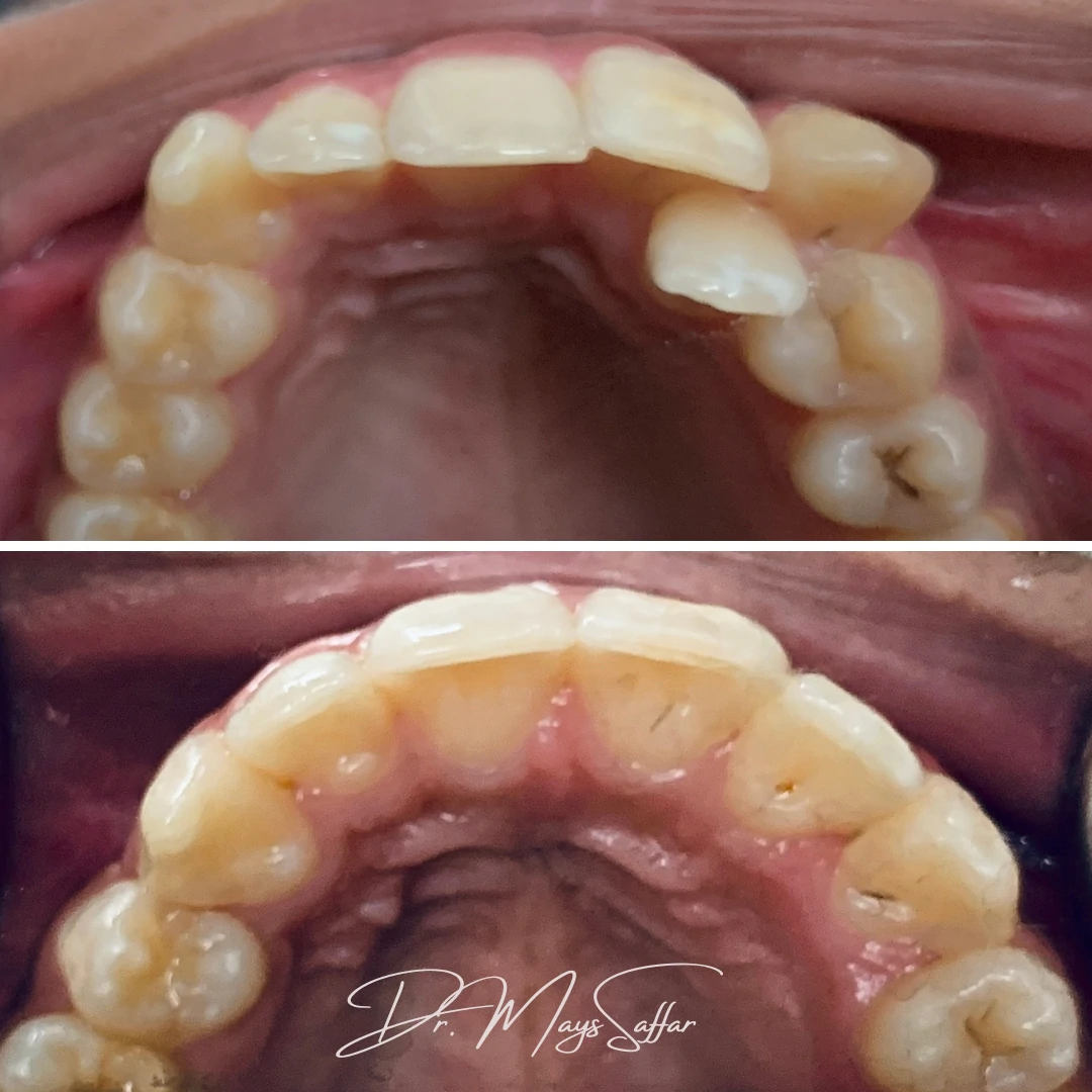 Orthodontic palatal expansion before and after showing wider arch at North Star Dentistry