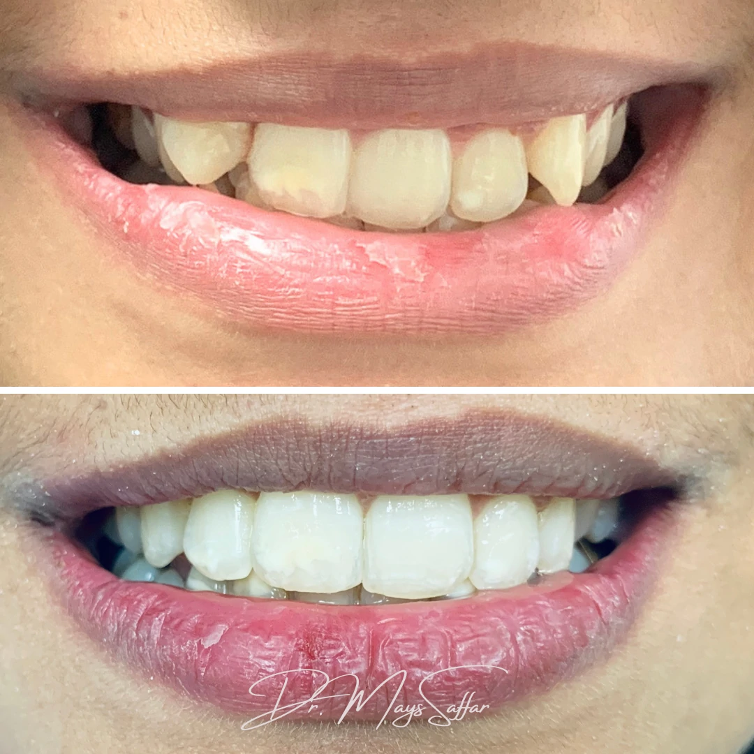 Orthodontic smile transformation before and after at North Star Dentistry Mississauga