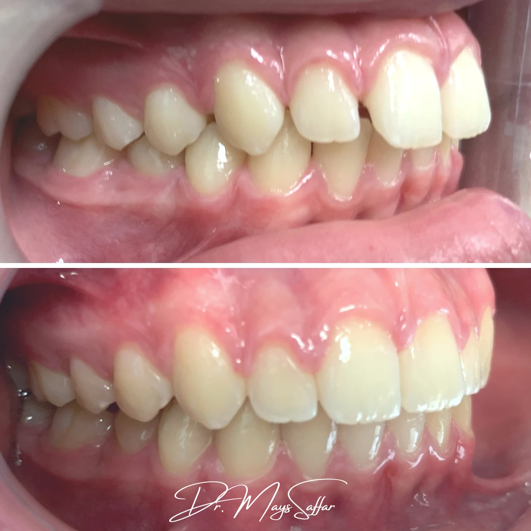 Orthodontic side profile bite correction before and after in Mississauga