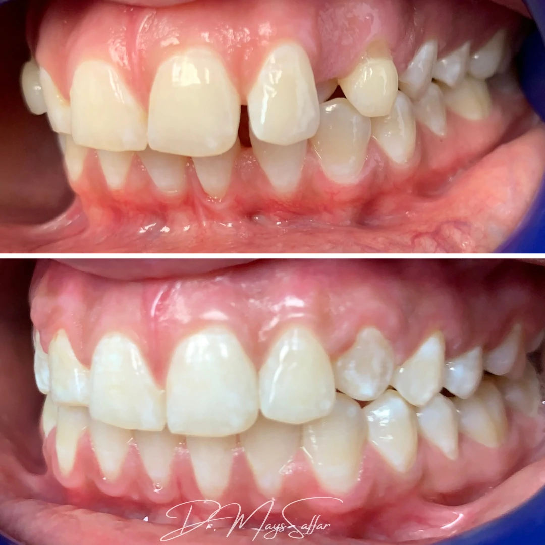 Orthodontic lateral teeth alignment before and after at North Star Dentistry Mississauga
