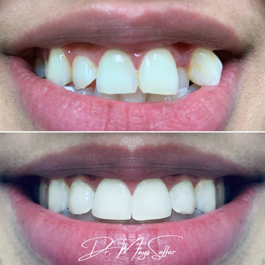 Orthodontic front teeth crowding correction before and after at North Star Dentistry Mississauga