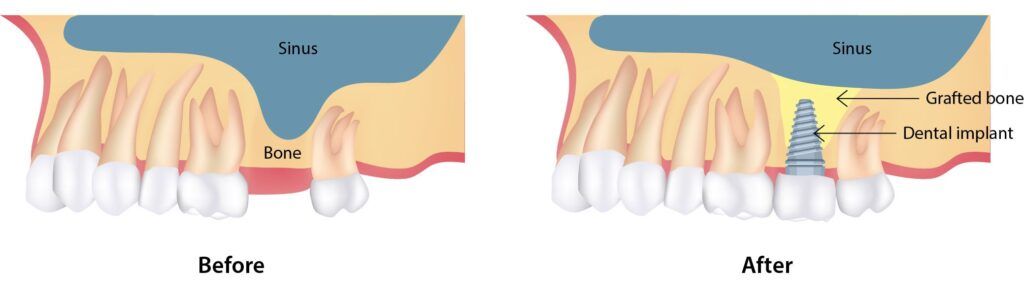Sinus lift procedure before and after illustration showing bone grafting and dental implant placement in the upper jaw – sinus augmentation in Mississauga