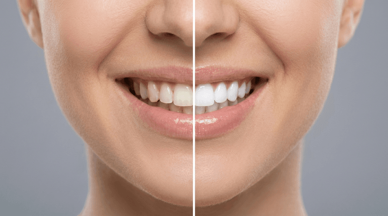 Teeth Whitening